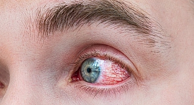 Bahar Alerjisinde Göz Ovalamak Körlüğe Yol Açıyor